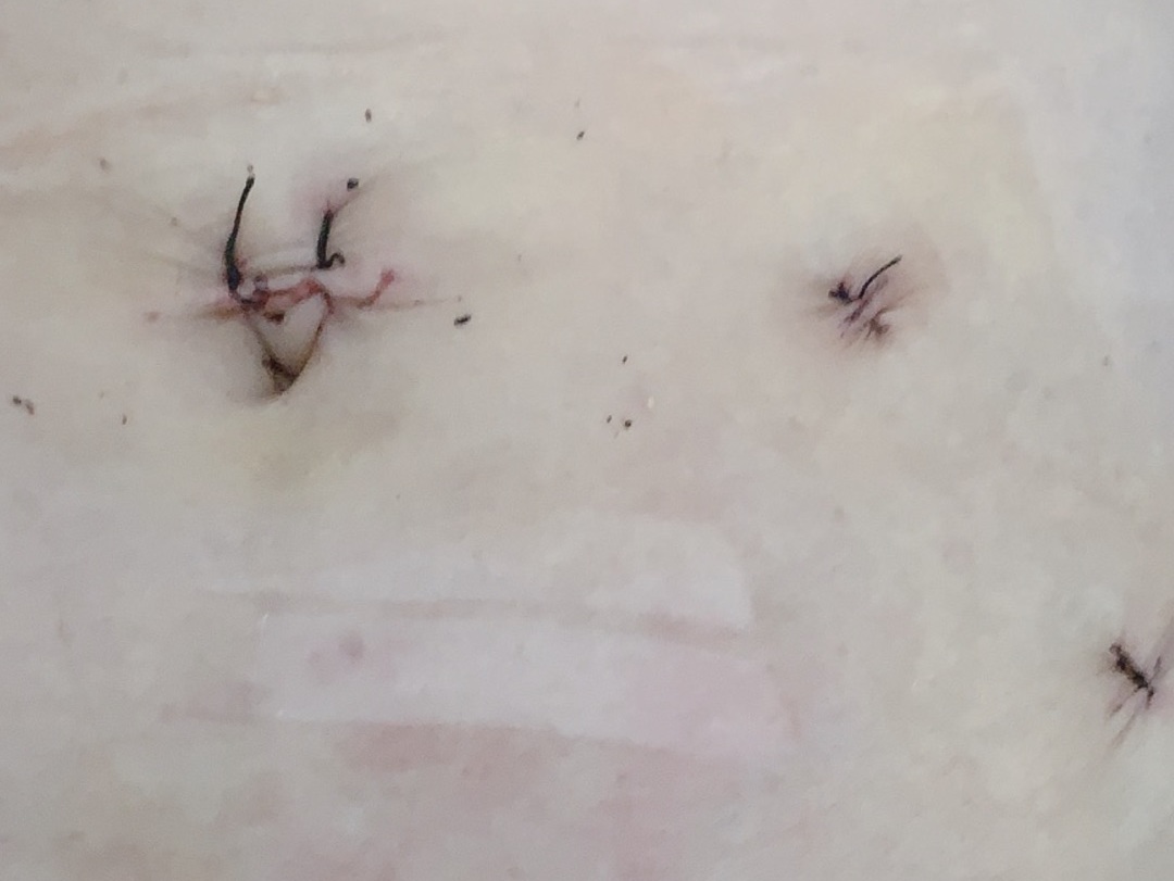腹腔镜子宫悬吊术子宫脱垂患者的福音