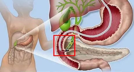 内镜下逆行胰胆管造影术不开刀也能取出石头
