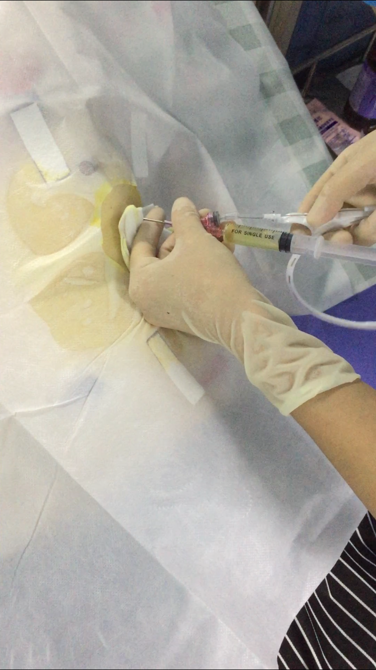 我院成功开展首例心包腔穿刺置管引流术