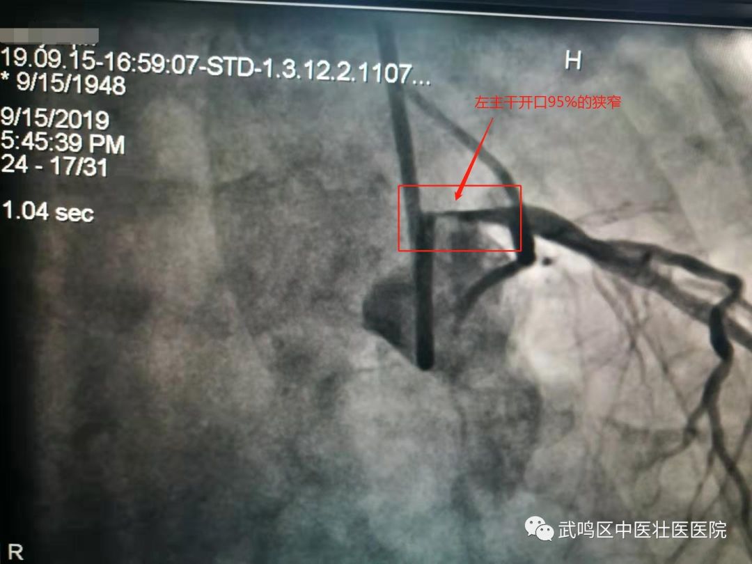 一名高龄急性心肌梗死患者神奇获救