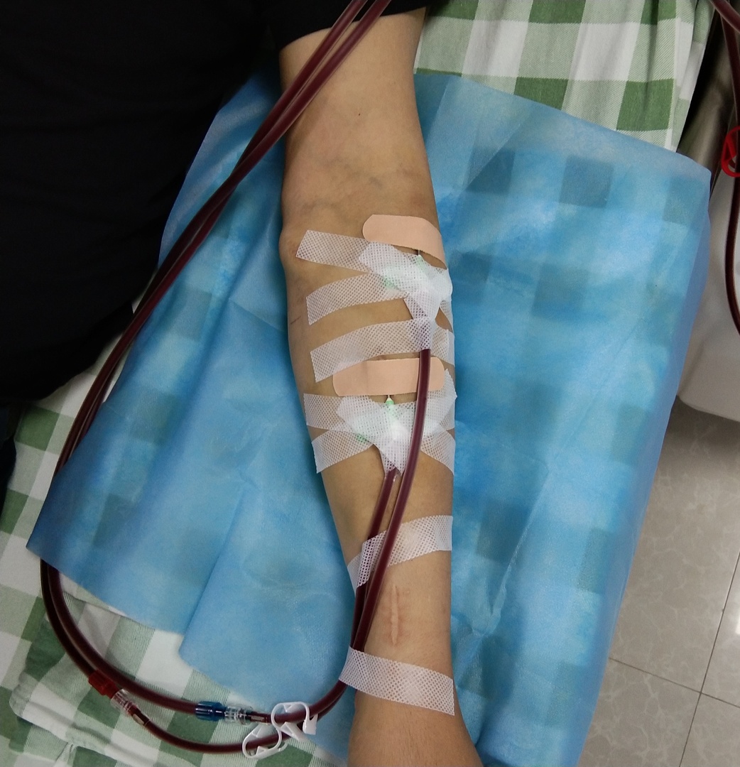 我院率先开展动静脉内瘘钝针扣眼穿刺术