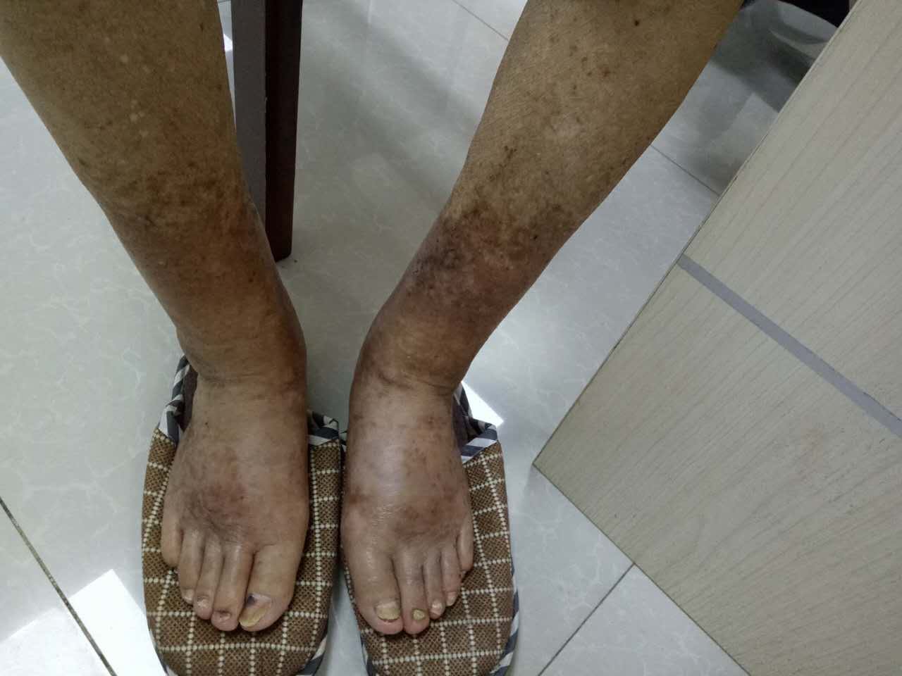 高招！壮医治疗头晕乏力水肿等效果佳 