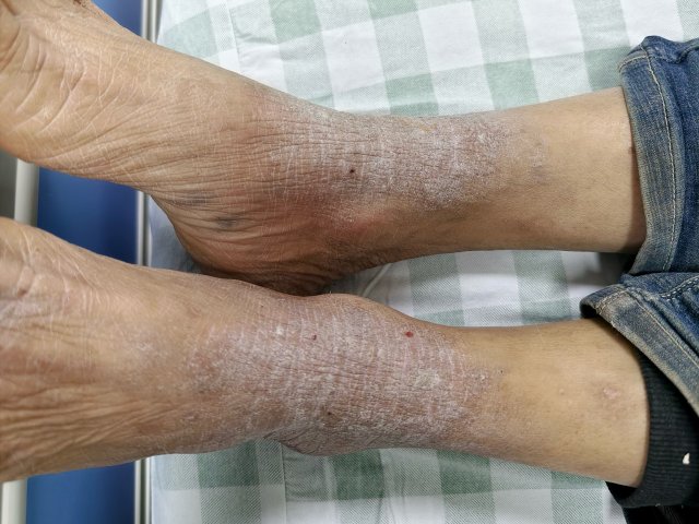 第三次刮痧图片2.jpg
